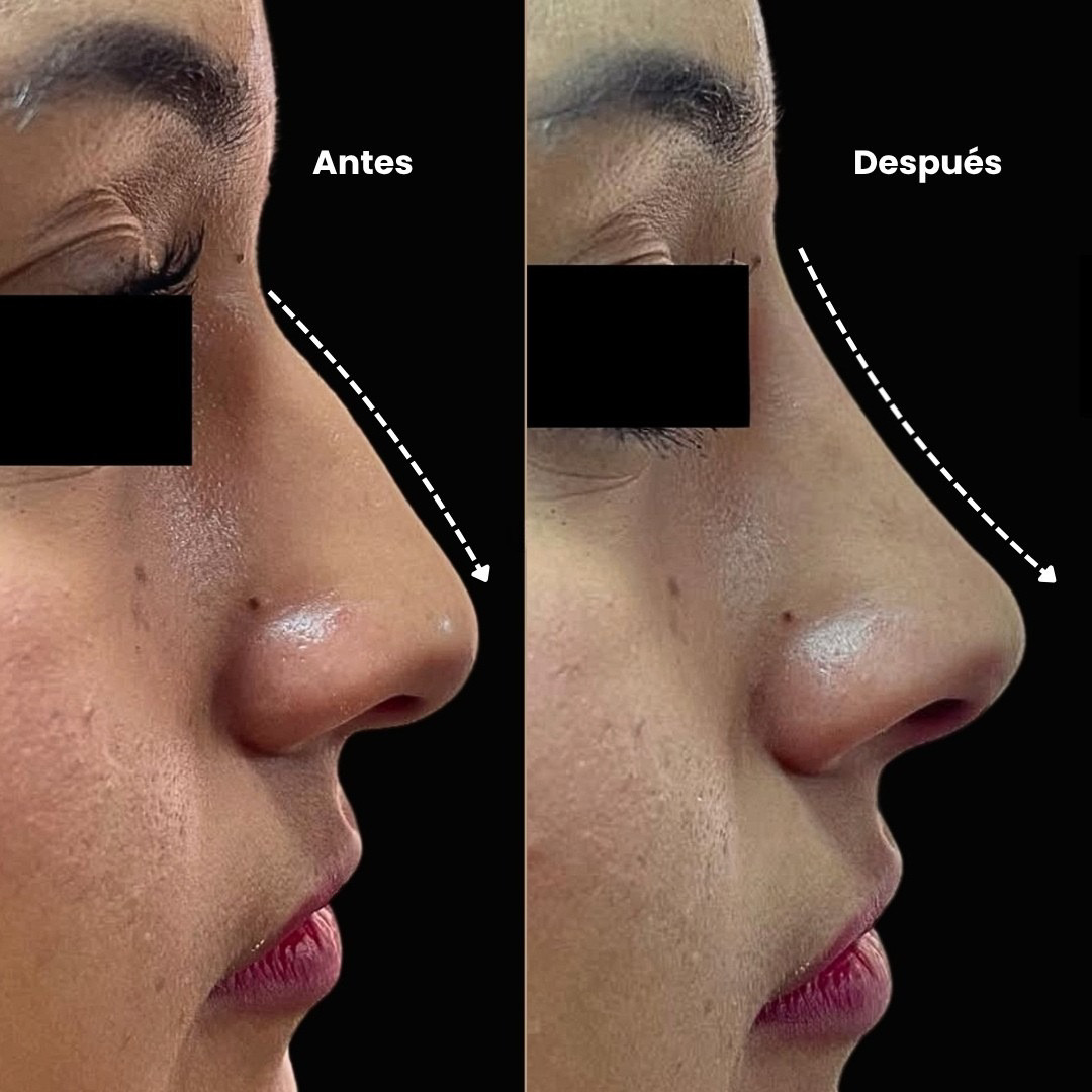 Caso real Nova Imagem · rinoplastia personalizada